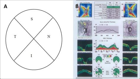 Retinal Nerve Fiber Layer Mapping Involving 4 Quadrants A And Retinal Download Scientific