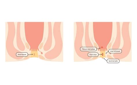 Anal Stenosis Royalty Free Images Stock Photos Pictures Shutterstock