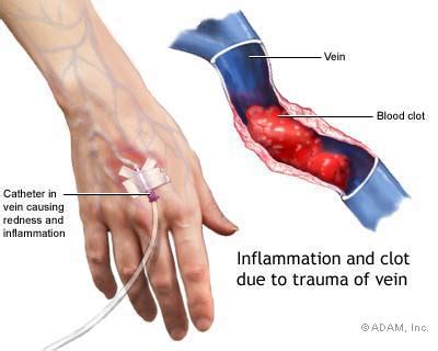 The New York Times Health Image Superficial Thrombophlebitis