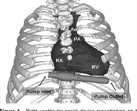 Figure 4 From Pediatric Mechanical Circulatory Support The Cleveland