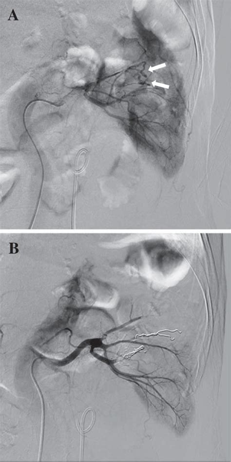 Selective Renal Angiography Selective Renal Angiography Revealed Renal