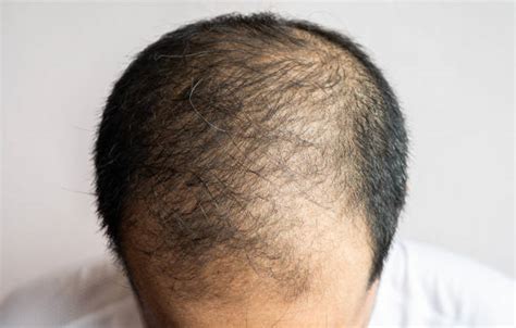 Understanding Male Pattern Baldness Causes Treatments And Coping