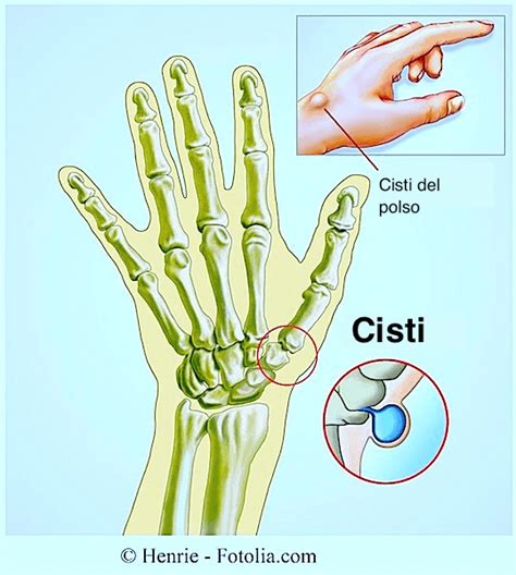 Cisti Del Polso Sinoviale Terapia E Intervento Chirurgico