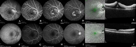 Fundus Fluorescein Angiography FFA And Optical Coherence Tomography