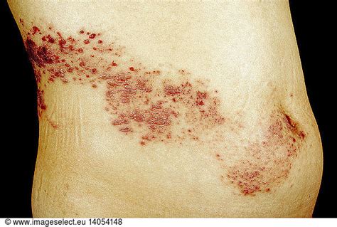 Herpes Zoster Rash On Abdomen Herpes Zoster Rash On Abdomen Abdomen