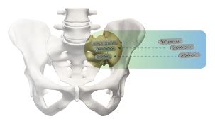 Si Bone Ifuse Implant System Marshall Health