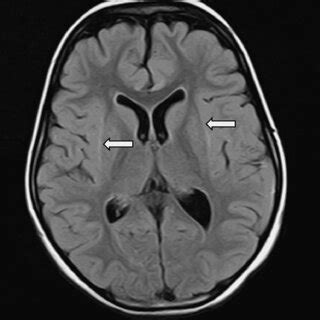 Magnetic Resonance Imaging Of The Brain Fluid Attenuated Inversion