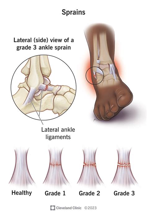 Ankle Sprain Grades 1