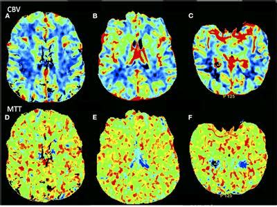 Frontiers Encephalopathy In Covid Presenting With Acute Aphasia