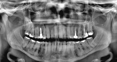 Focal Cemento Osseous Dysplasia