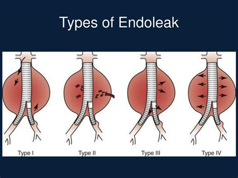 Ppt Abdominal Aortic Aneurysms Powerpoint Presentation Free Download