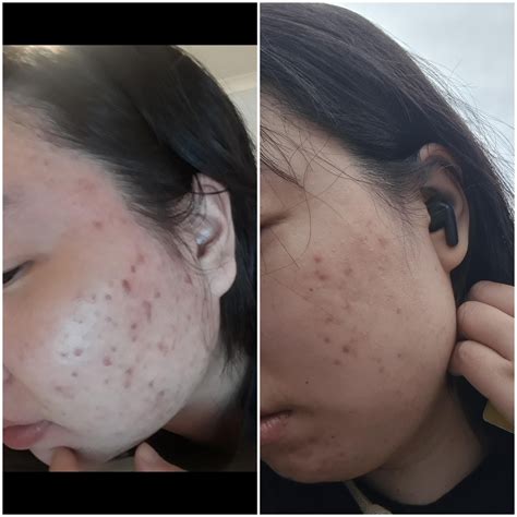 Before/after on accutane. : r/acne