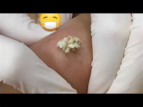 Cyst Extraction Youtube