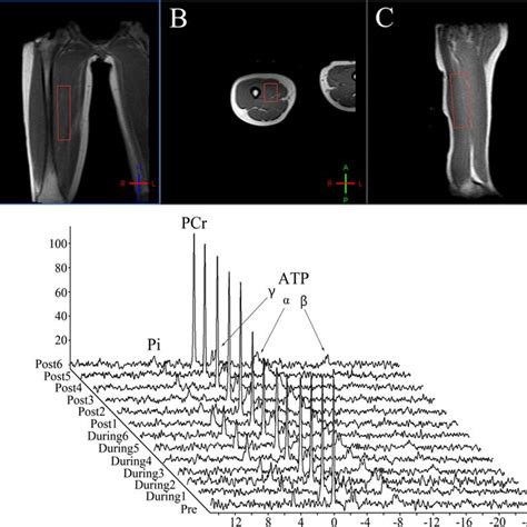 The 31 P Magnetic Resonance Spectroscopy Obtained From A Representative Download Scientific