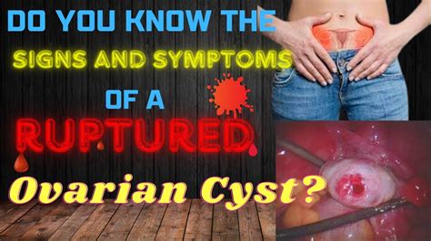 Explained Ruptured Ovarian Cyst Signs And Symptoms Youtube