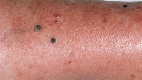 Nodular Melanoma Pictures Symptoms Treatment And More