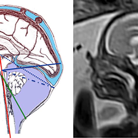 Anatomical Scheme And Mri Performed In A Fetus With A Posterior Fossa