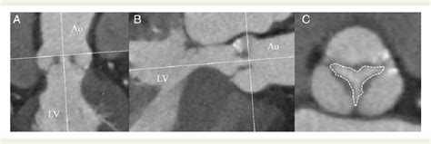 Figure From Value Of Anatomical Aortic Valve Area Using Real Time