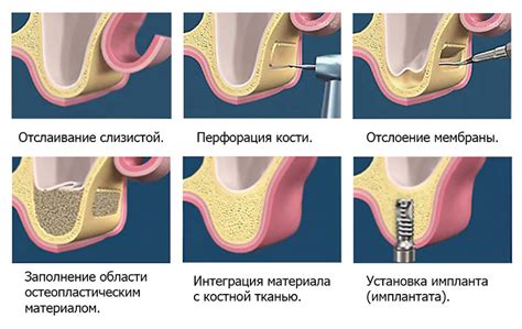Синус лифтинг (открытый, закрытый) - что это такое? Цена, отзывы ...