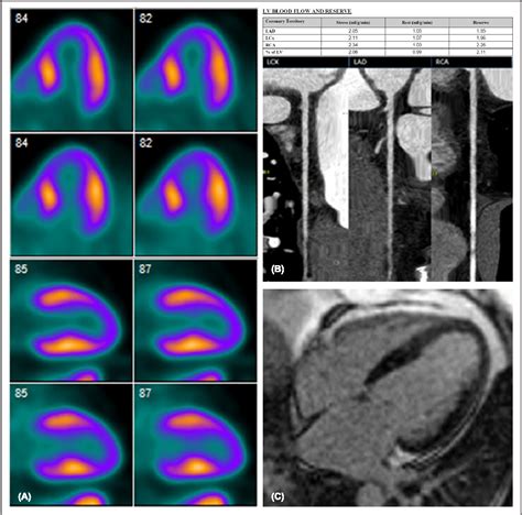 Figure 1 From Unveiling The Hidden Patterns Multimodality Cardiac Imaging In Takotsubo