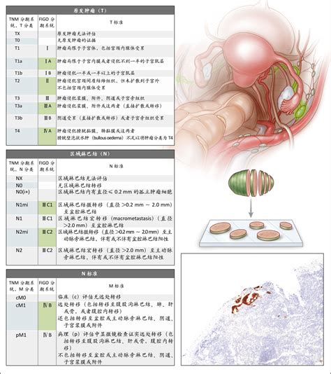 子宫内膜癌 Nejm医学前沿