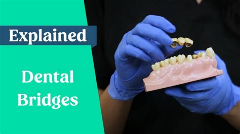 Dental bridges explained (False teeth alternative) - Dental Clinic