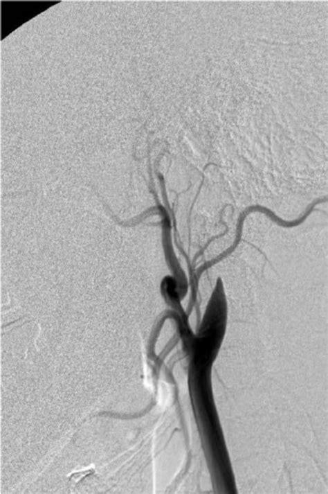 Left Common Carotid Angiograms Lateral View A Early Phase Image