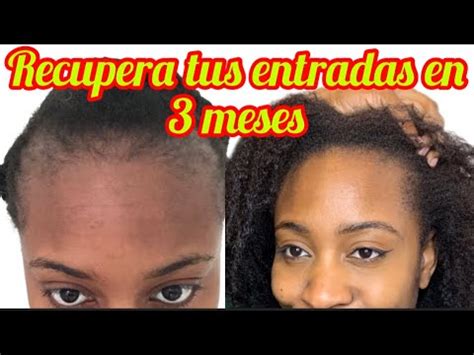 Como Hacer Crecer Pelo De Las Entradas Y Bordes En El Pelo Afro C