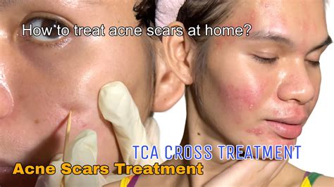 Diy Acne Scars Treatment Acne Scars Removal Diy Tca Cross At Home