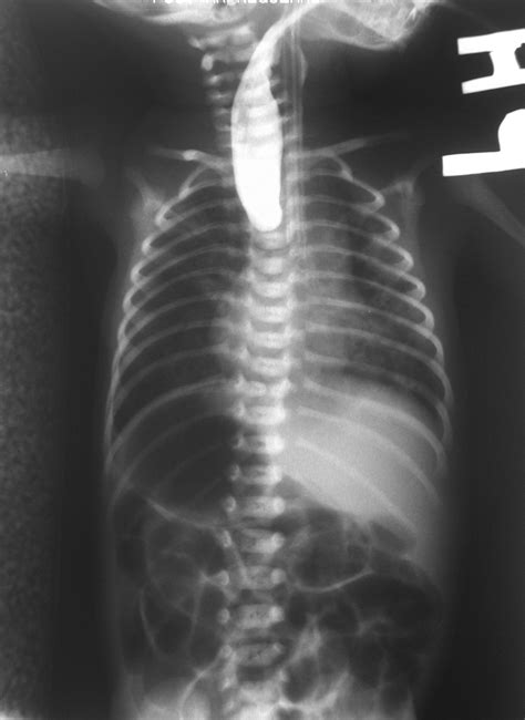 Esophageal Atresia Wikipedia