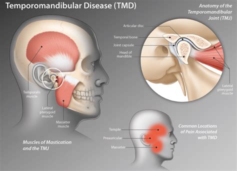 Tmj Disorder Specialists Near Me In Mumbai Lock Jaw Treatment