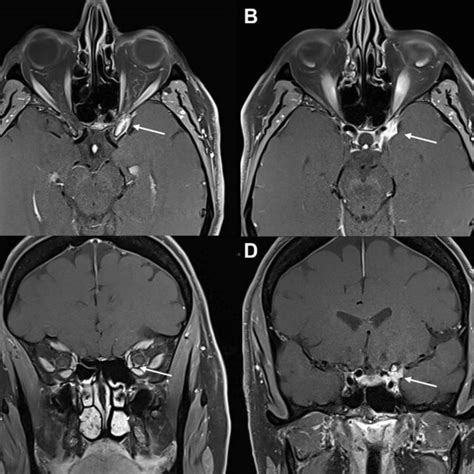 T2 Weighted Fat Suppressed Mri Scans For Case 2 A Coronal And B