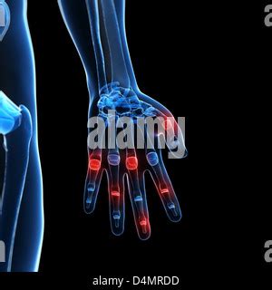 X-ray hand - arthritis Stock Photo - Alamy