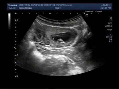 Ultrasound Video Showing Early Determination Of Sex In A Fetus YouTube