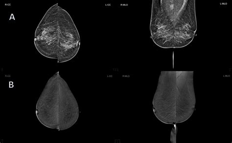 Frontiers Are Contrast Enhanced Mammography And Digital Breast