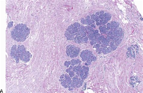 Lobular Carcinoma in Situ and Atypical Lobular Hyperplasia | Oncohema Key