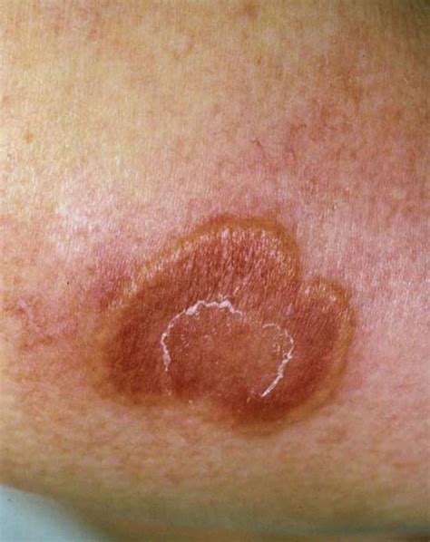 Acute Diffuse Rash On Distal Extremites Then Spread Proximal