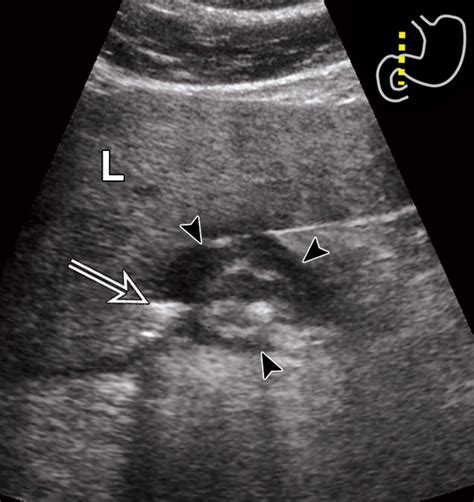 Stomach Ulcer Ultrasound