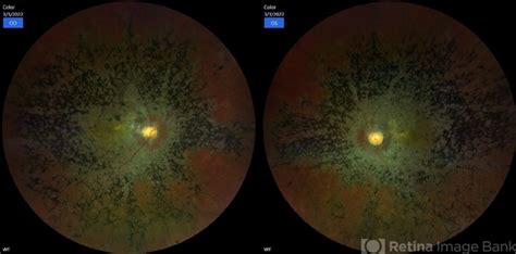 Pigmented Paravascular Retinochoroidal Atrophy Retina Image Bank