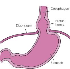 Hiatus Hernia Info: Hiatus Hernia Remedy