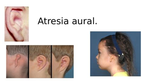 (PPT) Atresia aural | Moni Zavala Alegre - Academia.edu