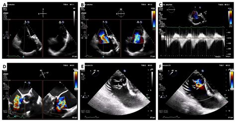 Lux Valve Plus Case Pre Procedural Transthoracic And Transesophageal Download Scientific