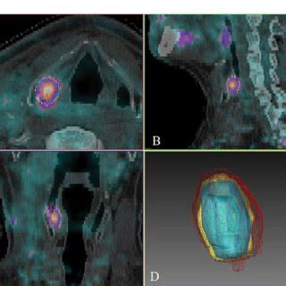 Interobserver Analysis Of 18 F FDG PET CT Gross Tumour Volume