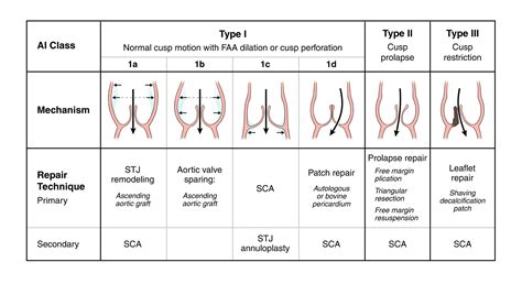 Aortic Valve Repair And Valve Sparing Aortic Root Replacement Adult And Pediatric Cardiac