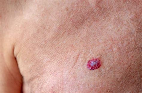 Comment Reconnaitre Un Carcinome Bp