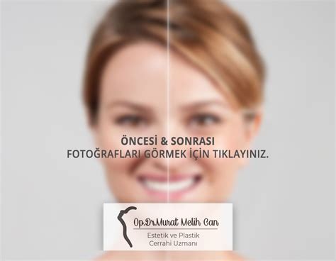 Op Dr Murat Melih Can Aesthetic and Plastic Surgeon İzmir