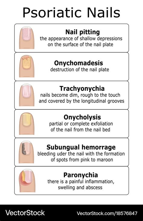 Of psoriatic nails Royalty Free Vector Image - VectorStock