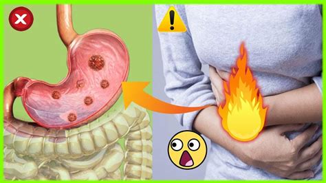Como Saber Se O Estômago Está Inflamado - Que Es El Estomago Inflamado at James Loch blog