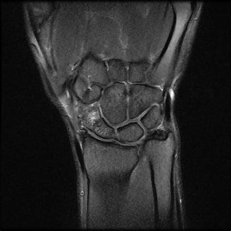 Avascular Necrosis Scaphoid Non Union Image