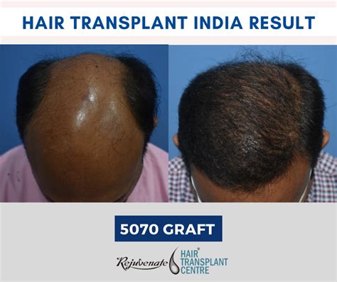 Hair Transplant Cost Best Hair Transplant In India Hair Clinic